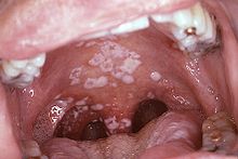 Candidose visible dans la bouche