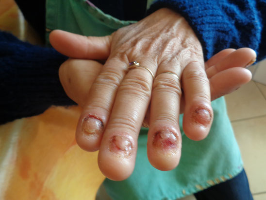 Candidose visible aux mains